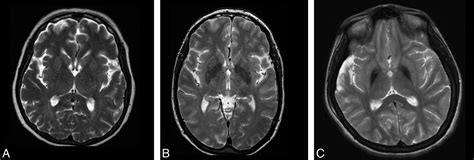 Neurodegenerative Brain Iron Accumulation