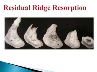 Residual Ridge Resorption Ppt