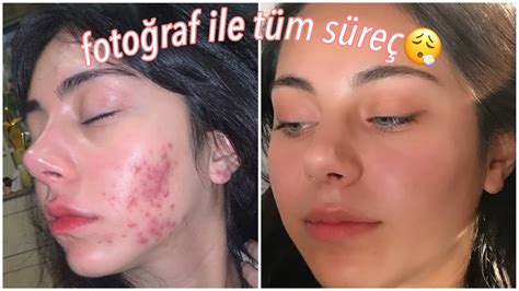 Roaccutane tedavisi