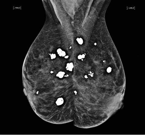 Should I Worry About Breast Calcifications