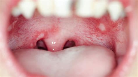 Single White Spot On Throat