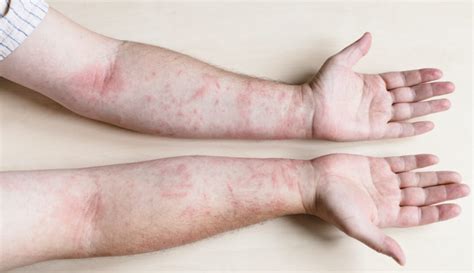 Skin Rash From Cold Weather