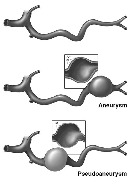 Splenic Artery Aneurysm Vs Pseudoaneurysm