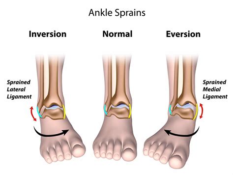 Sprained Ankle In Spanish