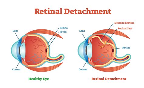 Treatment For Partially Detached Retina