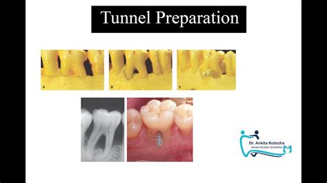 Tunnel Prep Dental Fillings