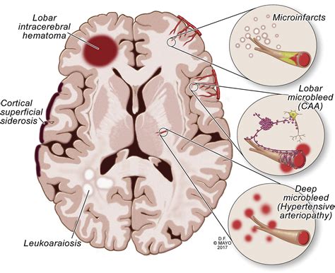 What Causes Amyloid Deposits In The Brain