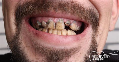 What Drug Causes Black Teeth