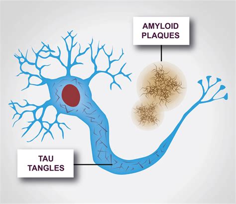 What Foods Cause Amyloid Plaques