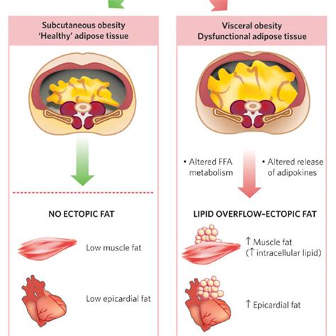 What Is Ectopic Fat Deposition