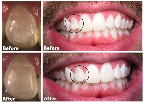 White Patches On Front Teeth